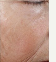 After · 12 weeks