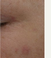 After · 8 weeks