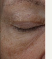 After · 15 weeks